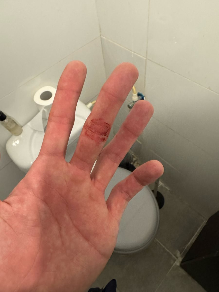 ידו החבולה של ג' לאחר האירוע. קרדיט: צילום פרטי